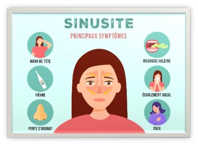 Spray Nasal Rhinitis